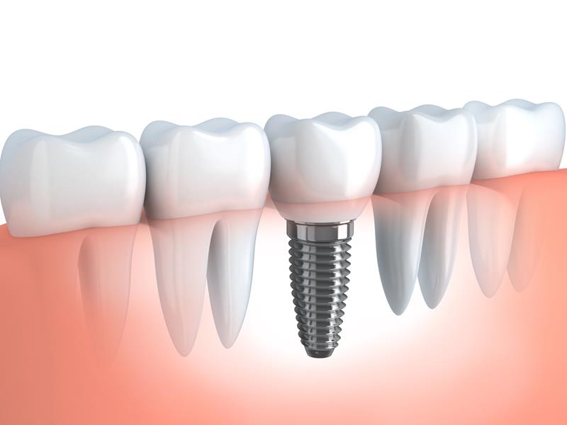 Dental Implants  New Ulm, MN 